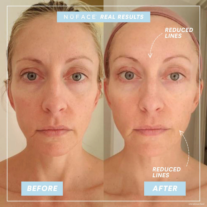 NuFACE Trinity Wrinkle Reducer Attachment (TWR)